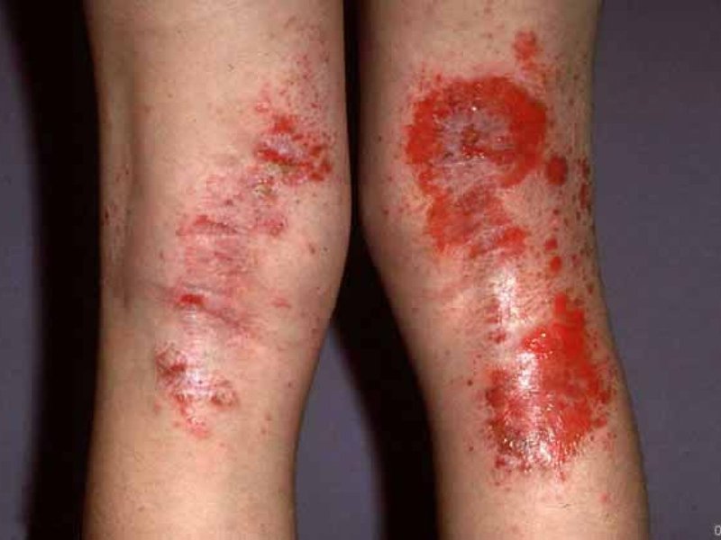Проявления дерматита на ногах