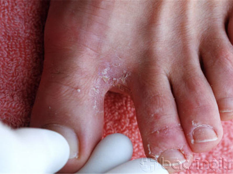 Причины появления грибка на ступне и между пальцами ног