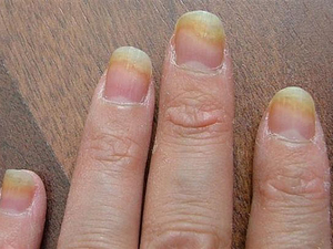 Разновидности грибка ногтей на руках