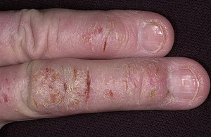 Проблема с кожей на пальцах