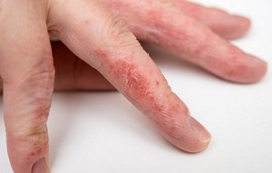 Как проявляется заболевание на пальцах