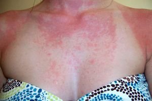 Перечень причин аллергических высыпаний на коже