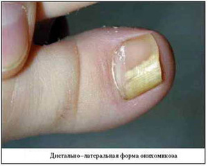 Виды грибка на ногтях могут быть разными.