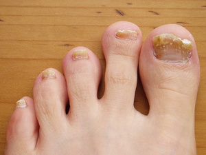 Грибковые заболевания ногтей на ногах проявляются повышением жесткости ногтя, изменением его вида.
