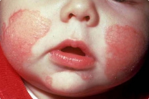 Экссудативный диатез проявляется у малышей на щеках.