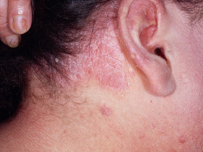 Методы лечения себорейного дерматита