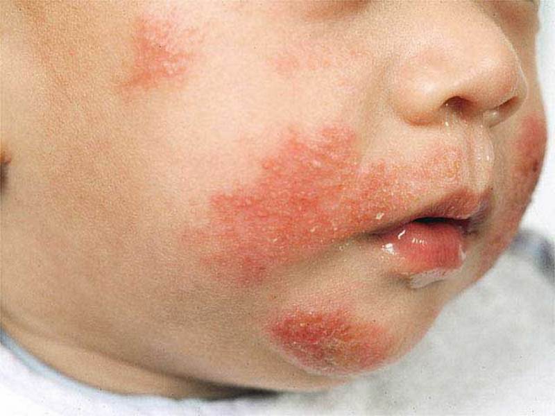 Детский пеленочный дерматит