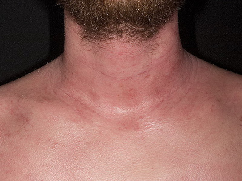 Атопический дерматит на шее  появляется реже, чем на конечностях.