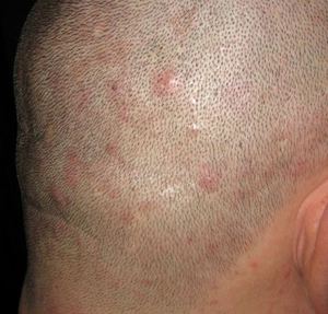 Прыщи в волосяном покрове головы могут быть аллергическими или сигнализировать о других проблемах.