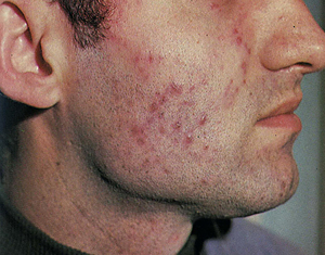 Какими препаратами лечить туберкулез кожи