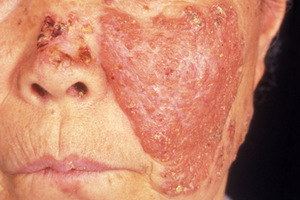 Форма туберкулеза кожи