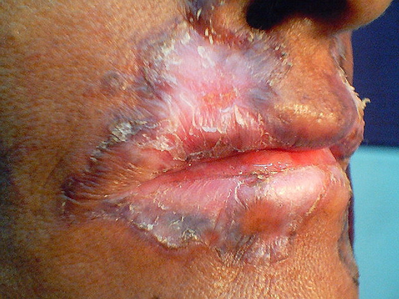 Проявление заболевания туберкулез кожи