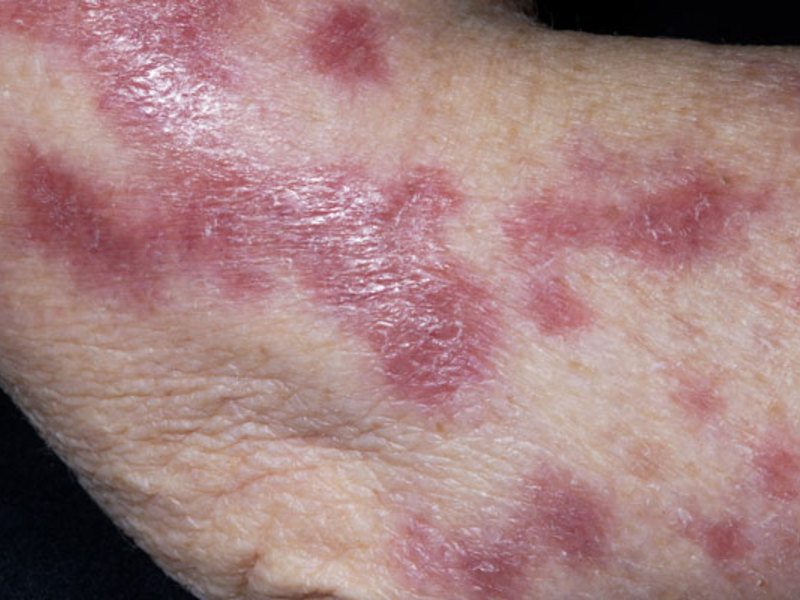 Как избавиться от заболевания туберкулеза кожи