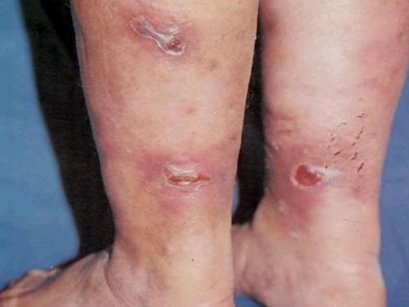 Какова зона поражения кожи теберкулезом