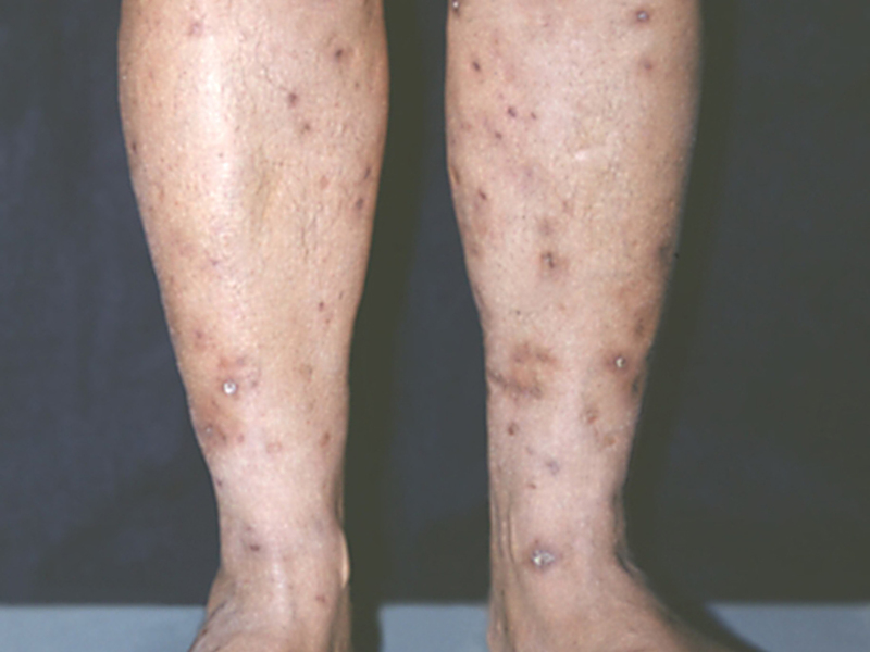 Виды заболевания туберкулез кожи