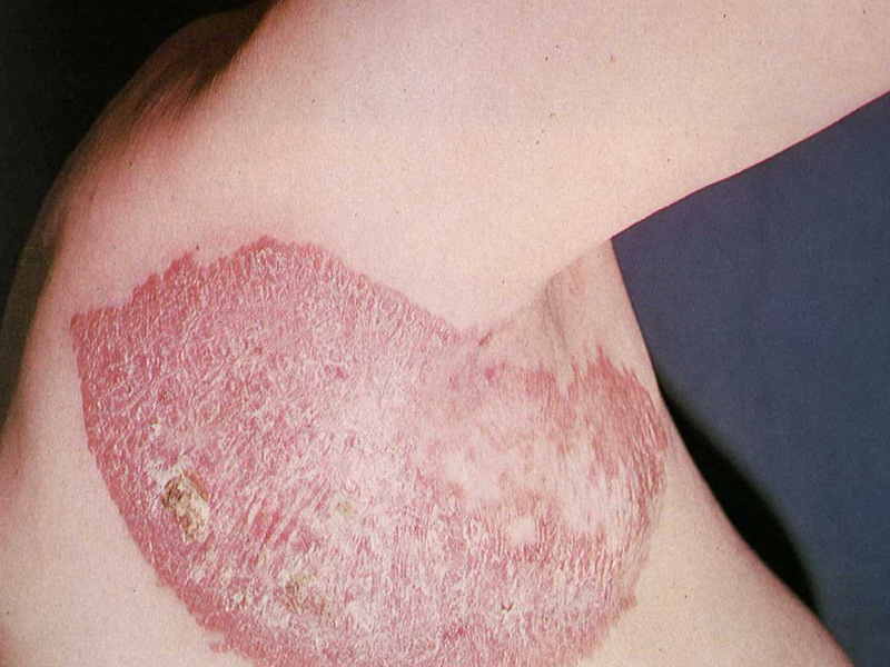 Как вылечиться от заболевания туберкулеза кожи