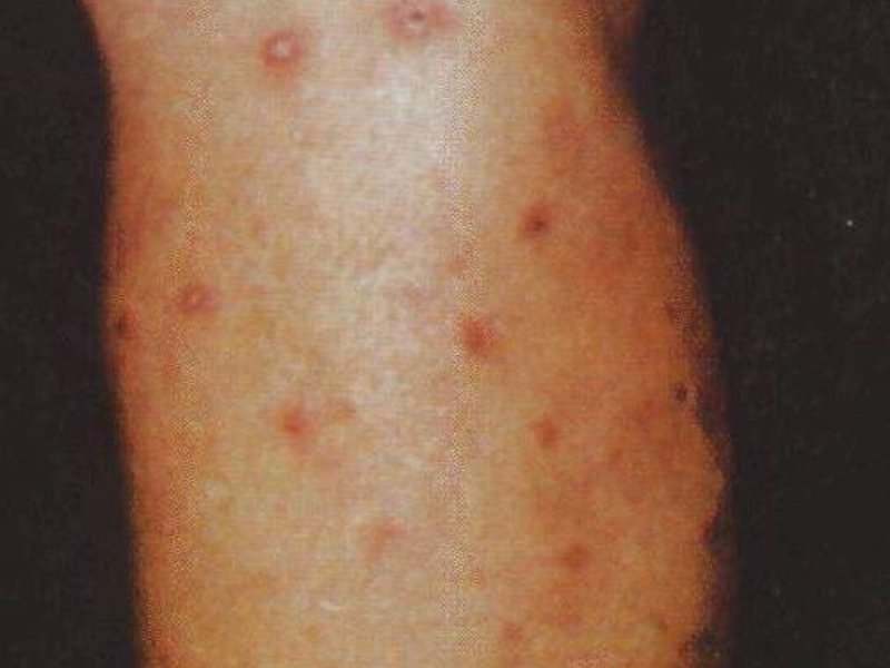 Методы излечения туберкулеза кожи