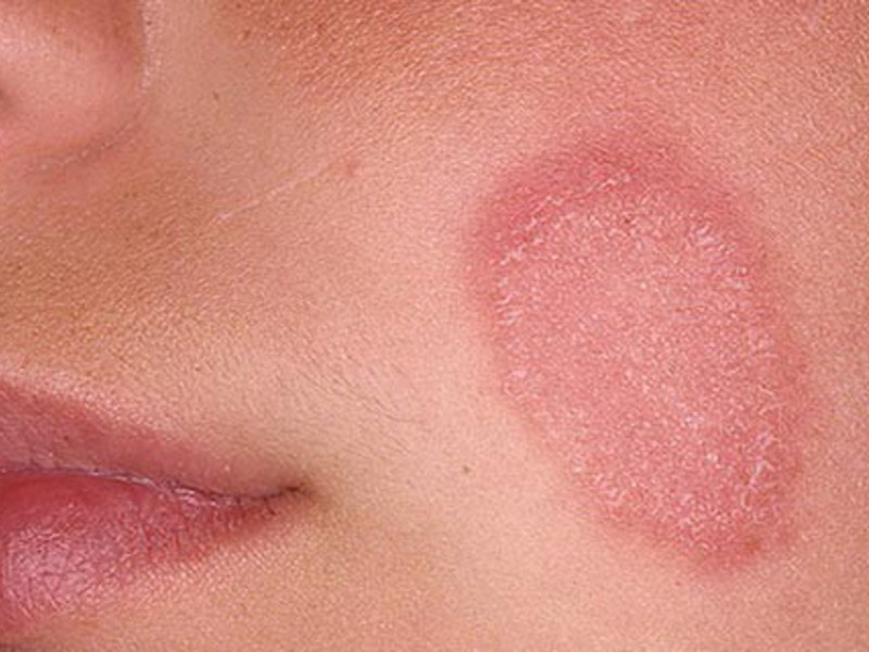 Розовый лишай на лице возникает так же часто, как и на других частях тела.