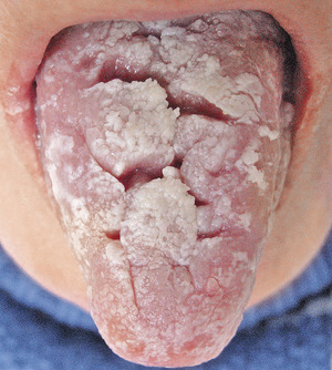 Эрозивно-язвенная форма лишая проявляется на языке и в полости рта.