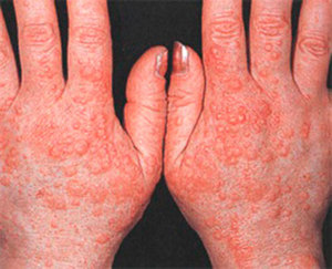 Аллергия на руках появляется по самым разным причинам.
