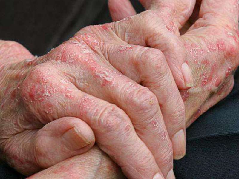 Хроническая аллергия на руках - это высыпания, которые появляются регулярно.