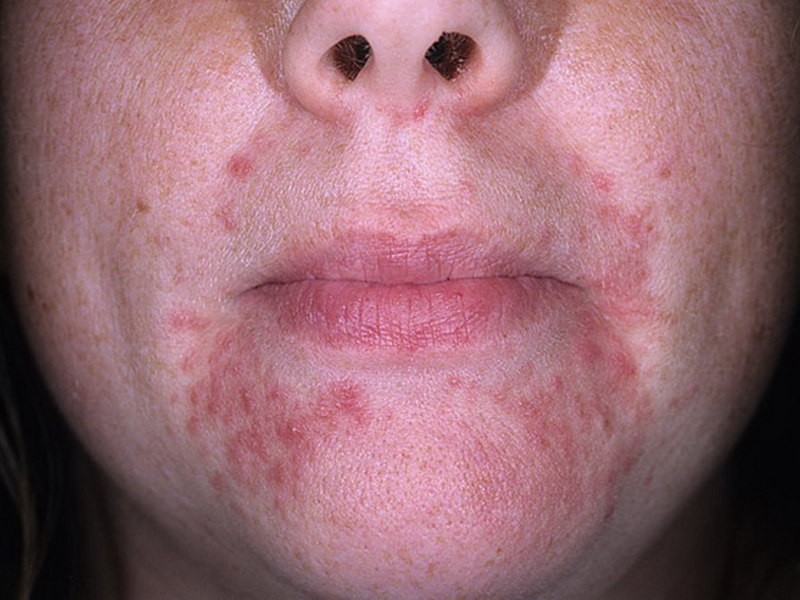 Чем можно обработать дерматит на лице
