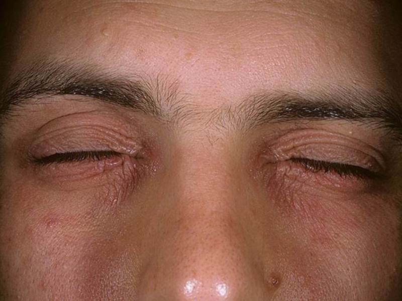 Признаки и симптомы контактного дерматита