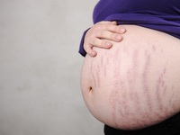 Растяжки часто возникают на последних месяцах беременности.