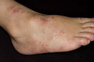 Какими симптомами характеризуется дерматит