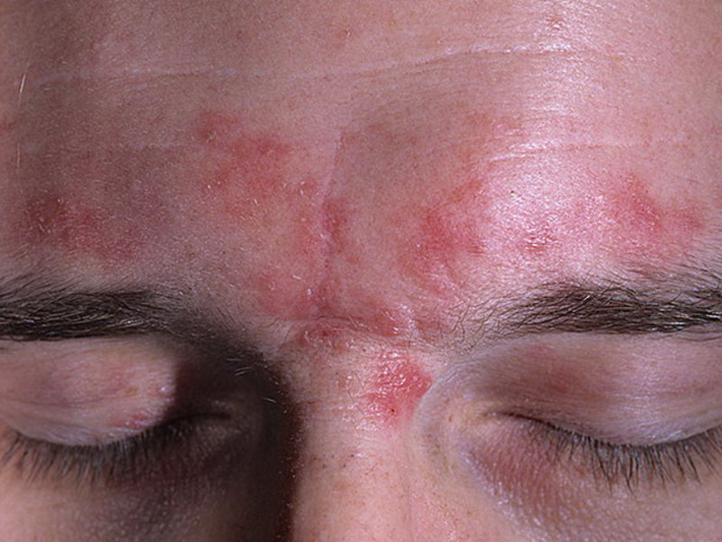 Лечение розовых угрей на лице