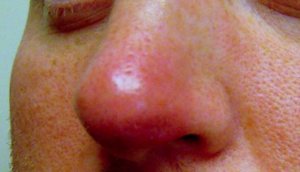 Фурункул может появиться не только на коже, но и, например, в носу