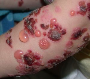 Как выглядит буллезный дерматит