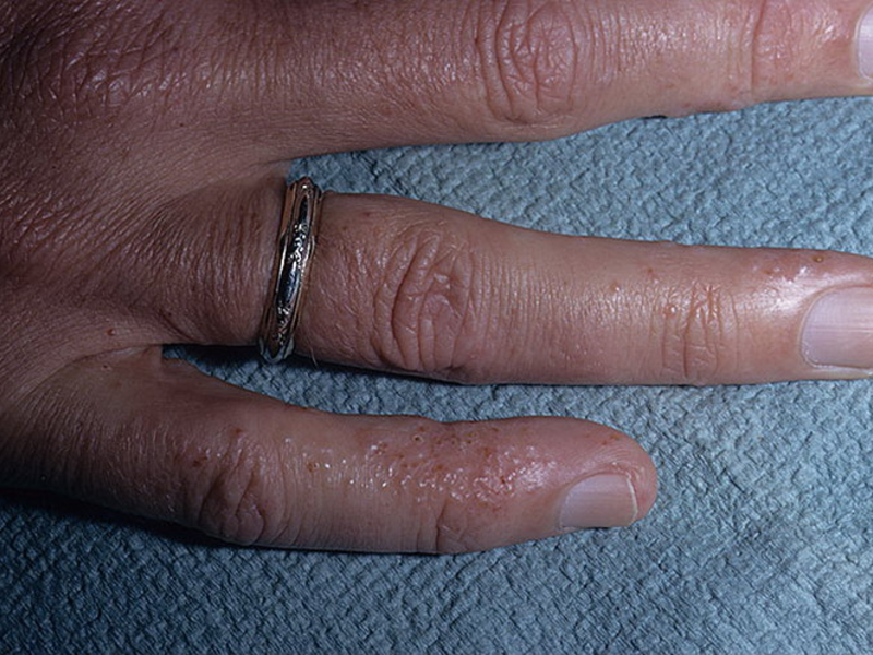 Диагностика заболевания дисгидроз кистей рук