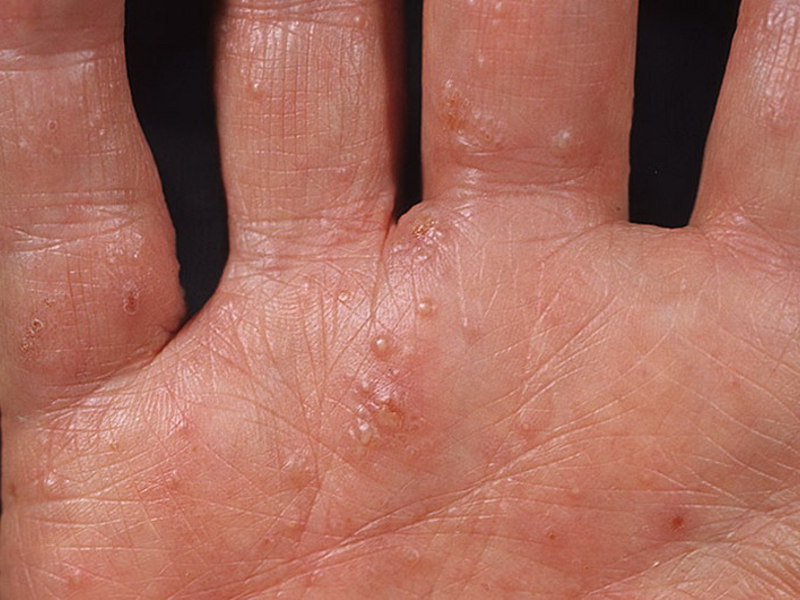 Методы лечения заболевания дисгидроз кистей рук