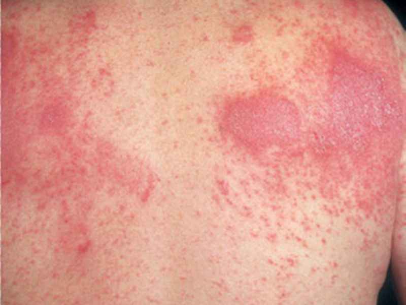 Симптомы кожных заболевания