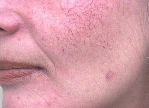 Причины купероза на лице