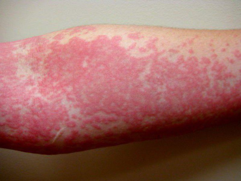 Как проявляется аллергия на теле на нервной почве
