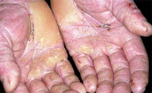 Проявление дерматита на ладонях