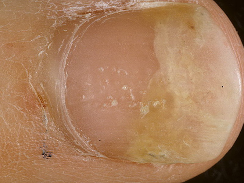 Методы лечения псориаза на ногтях