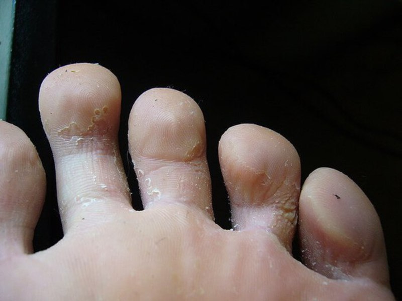 Как избавиться от озолей на пальцах ногм