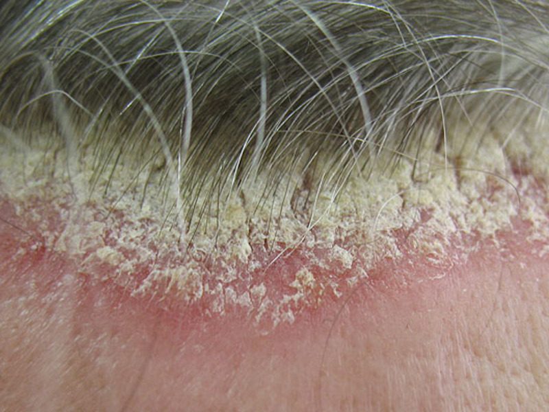 Обострения псориаза характеризуются зудом и повышением количества шелушащейся кожи.