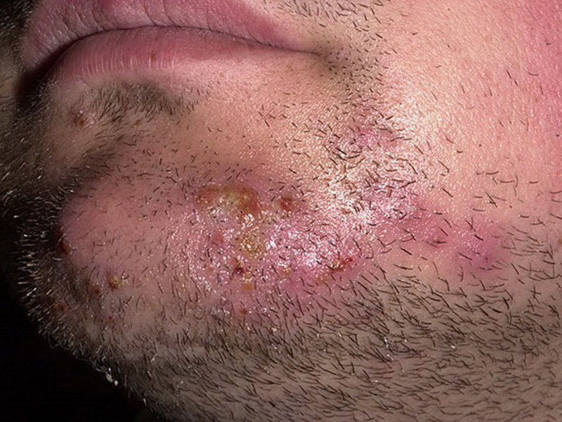 Как выглядит пораженная зона кожи микозом