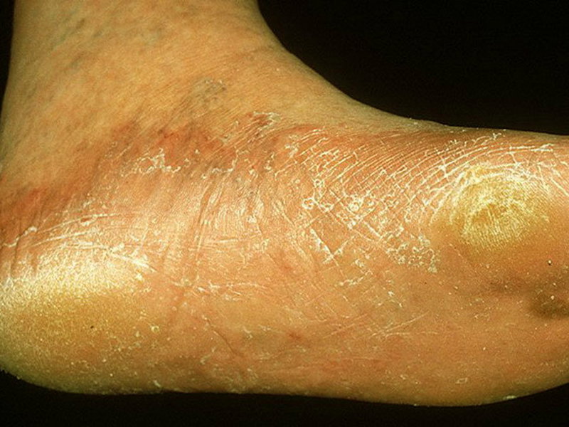 Проявления микоза кожи