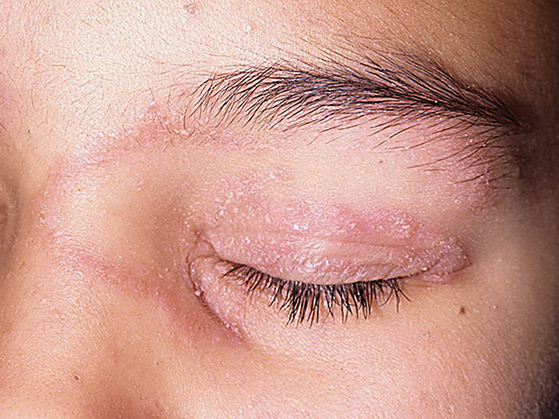 Методы лечения кожных заболеваний