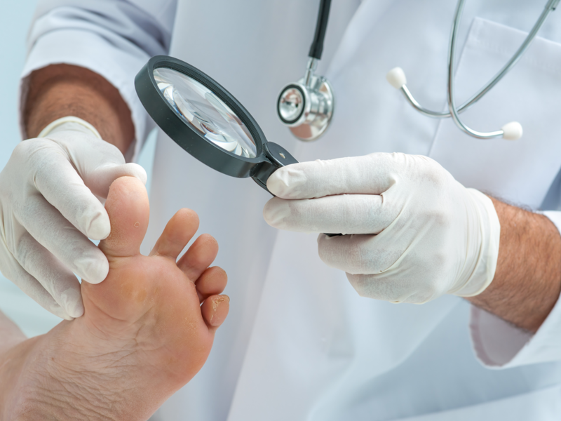 Особенности диагностики заболевания грибком ног