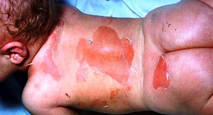 Пеленочный дерматит возникает при недостаточном уходе за ребенком.