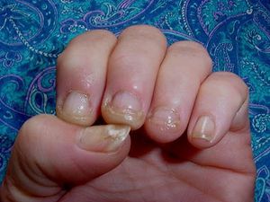 Симптомы и признаки дрожжевого микоза ногтей рук