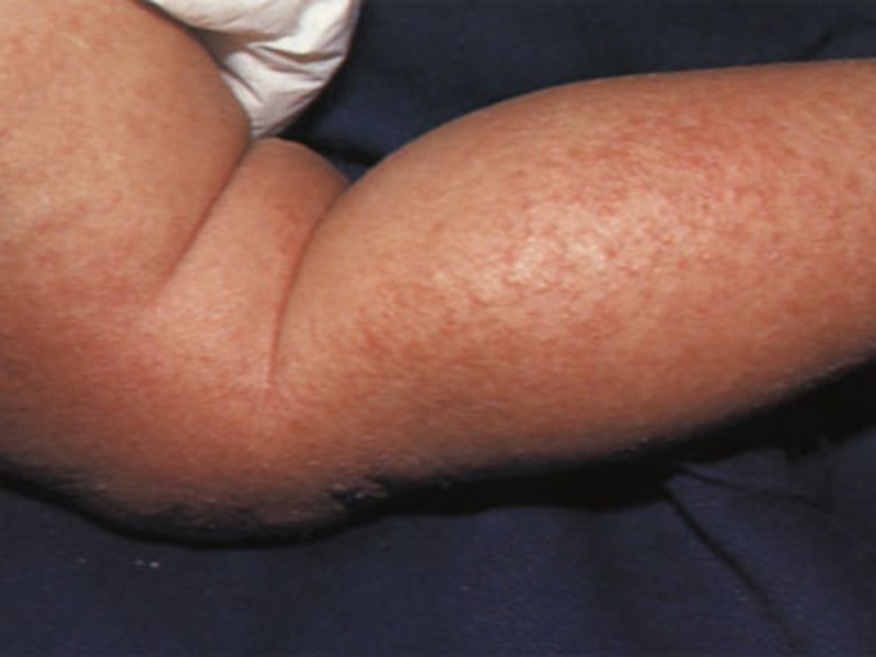 Младенческая форма дерматита атопического показана на фото.