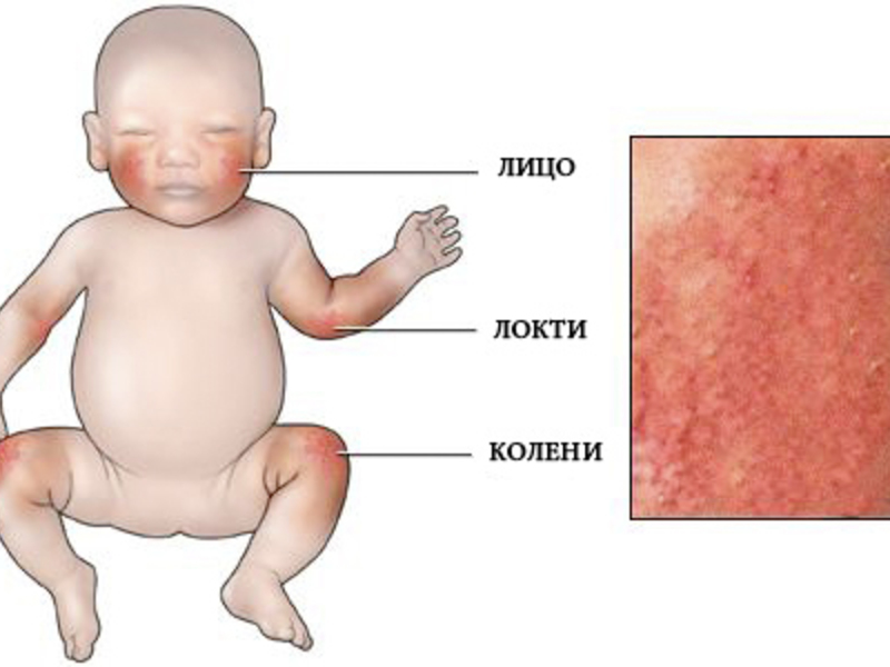 Как проявляется атопический дерматит  у маленьких детей видно на рисунке.