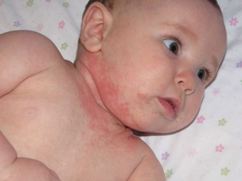 Аллергический дерматит в маленьких детей лечится, прежде всего, исключением из рациона продукта-аллергена.